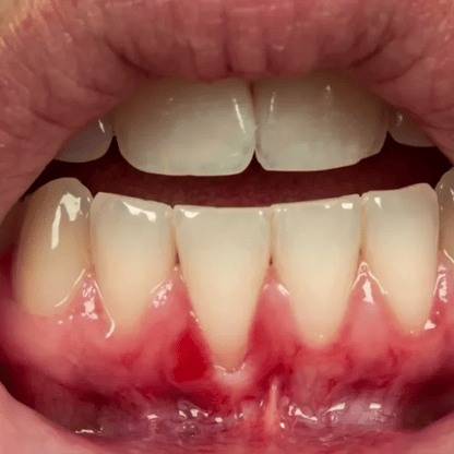 🦷 Colágeno - Recupera tus encías y tu sonrisa en 21 días